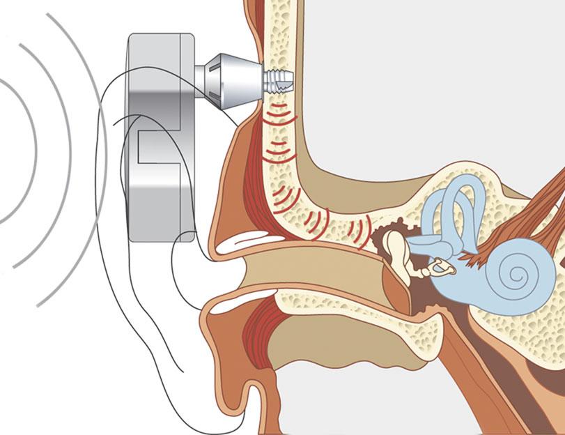 Próteses Osteoancoradas - Dra. Vanessa Mazanek